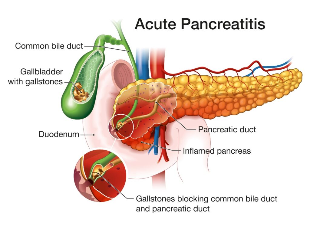 pancreatitis acute
